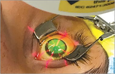Figure 3. Once flare is noted, the cornea is irradiated with UV light at an energy level of 3.0mW/cm2 for 30 minutes. Courtesy of Avedro