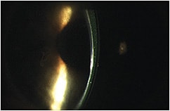 Figure 3. Entrapped debris in the fluid reservoir.