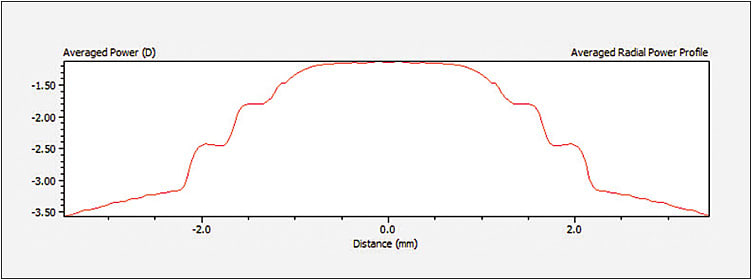 Figure 4. This center-near lens has a large, approximately 2mm diameter area in the center in which the most plus power is achieved. There is a stepped approach as the lens power increases in minus, realizing the labeled –3.00D distance power at about the 4mm pupil diameter. Some experts would argue that the stepped approach (versus the sloped approach in Figures 3 and 5) causes different types of optical aberrations that may be deleterious to vision under certain circumstances, such as low-contrast scenarios.