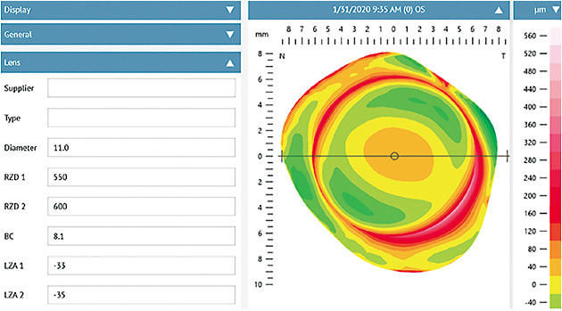 Figure 17. Orthokeratology lens parameters obtained from profilometry. For this patient who had corneal astigmatism, a dual axis design was recommended. Image courtesy of Jason Jedlicka, OD
