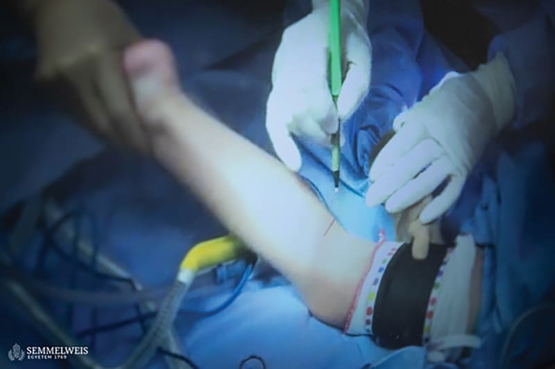 A 15-centimeter nerve fiber was removed from the patient’s lower leg.