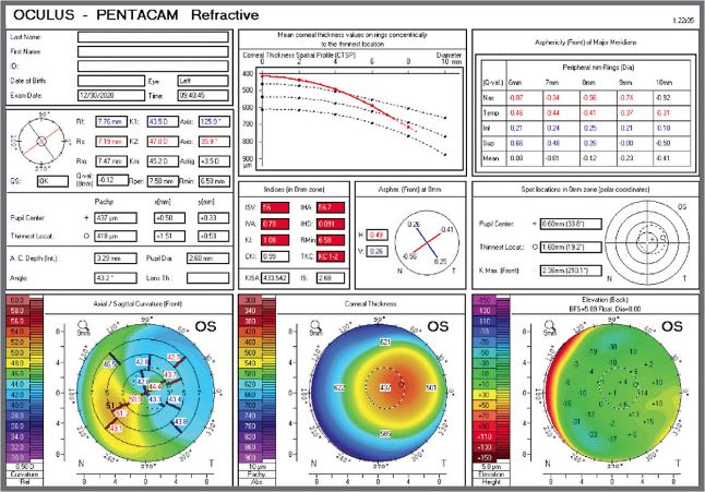Note how TCAT helped this patient who had a partially retained lenticule after SMILE. IMAGE COURTESY MARK LOBANOFF, MD.