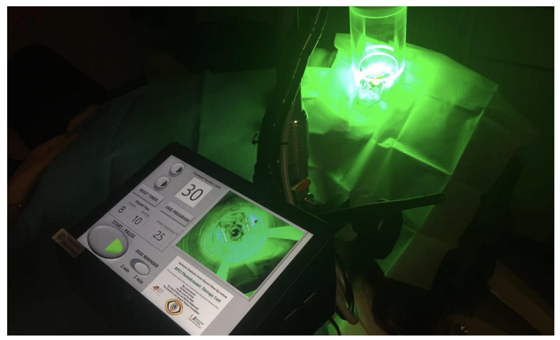RB-PDAT consist of two phases; a soaking phase and an irradiation phase. It begins with the soaking phase by applying the Rose Bengal solution (0.1%) to the cornea for 30 minutes followed by irradiation phase which uses the custom-made green LED source (525nm) at 6mW/cm (5.4J/cm 2) for 15 minutes. Currently the University of Miami holds the patent for the design of this product.