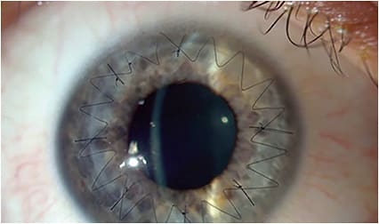 FIGURE 2. Note the preoperative topography of a patient with a nasal pterygium showing classic flattening and irregular astigmatism. IMAGE COURTESY ASHLEY BRISSETTE MD, MSC, FRCSC