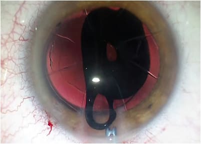 FIGURE 2: Note the insertion of the flexible pinhole device into the ciliary sulcus. IMAGE COURTESY MICHAEL E. SNYDER, MD