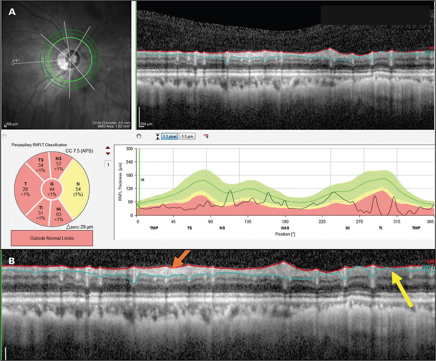 Figure 1. An OCT report (A) of a highly myopic eye with advanced glaucoma and OCT RNFL thickness of only 44 µm, showing a circumpapillary RNFL B-scan image, which is enlarged in panel B. Regions with remaining RNFL (orange arrow) and without remaining RNFL (yellow arrow) can be seen. The summary statistics and the segmentation lines (red and blue lines) cannot necessarily be trusted.