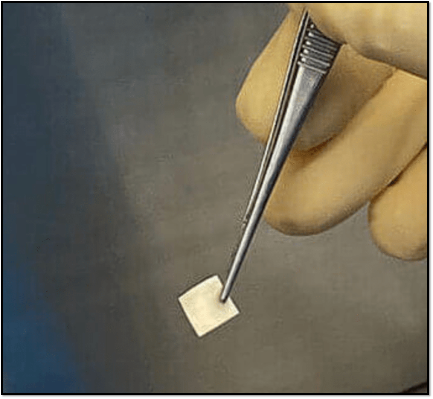 Figure 1. Scleral allograft.