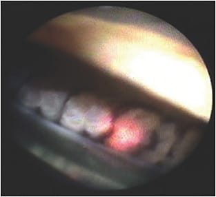 Figure 2. Laser is aimed at the posterior half of the ciliary process to shrink posteriorly. Untreated processes are positioned anteriorly. Image courtesy of Ike Ahmed, MD.
