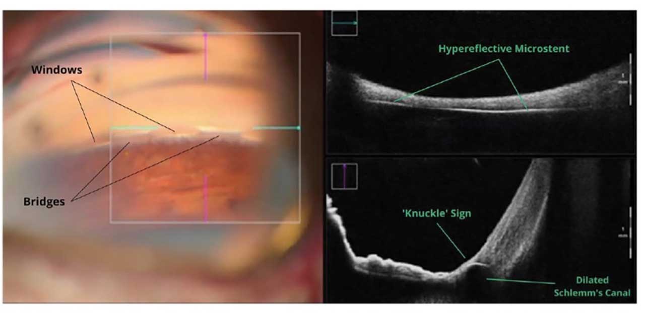 Figure 3. Optimally placed Hydrus microstent (Alcon), visualized on intraoperative optical coherence tomography (iOCT) over the microstent spine/bridge. On the vertical axis, the “knuckle” sign may be appreciated (a single curved hyperreflective line pushing up against the junction of the iris and cornea, causing a slight convex displacement of the angle toward the anterior chamber).
