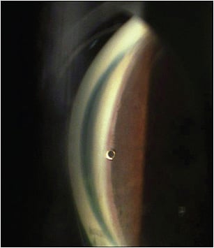 Figure 3. iStent Supra (Glaukos). PHOTO COURTESY OF STEVEN VOLD, MD