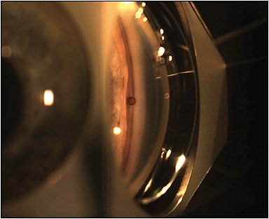 Figure 2. Cypass Micro-Stent (Alcon). PHOTO COURTESY OF STEVEN VOLD, MD