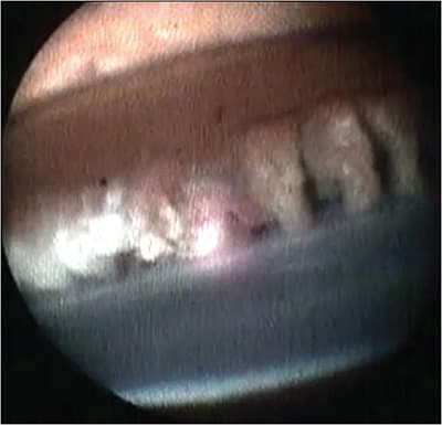 Figure 3. Surgical photograph showing the application of laser during endoscopic cyclophotocoagulation with the laser probe inside the eye treating the ciliary processes. Note the treated ciliary processes are whitened and shrunken (left side) compared to the untreated ciliary processes (right side). The red aiming beam is in the middle, the posterior surface of the iris above, and the lens capsule is below.