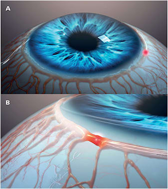 Figure 1. Representation of iTrack (Nova Eye Medical) surgical procedure, wherein the surgeon uses a microcatheter, which has an LED light at its tip (A), to traverse Schlemm's canal and then deliver ophthalmic viscosurgical device (B).