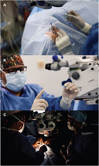 Figure 2. The iTrack surgical procedure (A), device (B), and microscope (C).