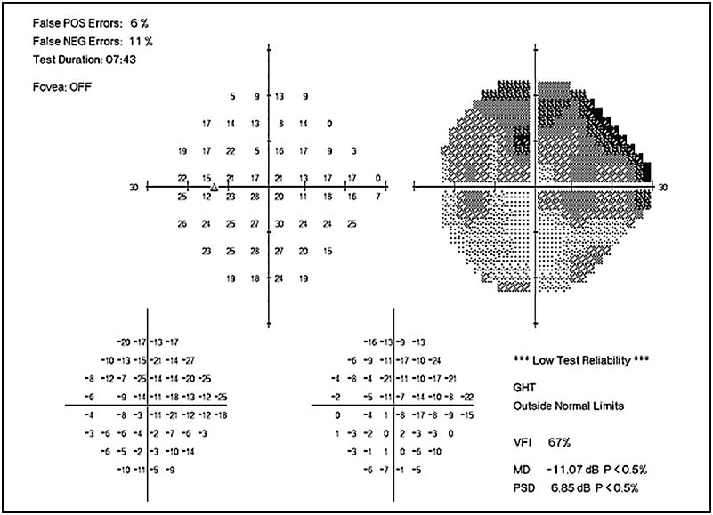 Figure 1. Standard automated perimetry of the left eye in a 73-year-old female patient with severe, refractory open-angle glaucoma.CASE CREDIT: DAVID STEPHENS, MD; TYSON EYE, FORT MYERS, FLORIDA