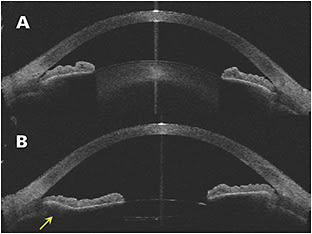 Figure 1. Preoperative optical coherence tomography (A) shows that the angles are narrow. Postoperative optical coherence tomography (B) shows that endocycloplasty has opened the angles (arrow). Image courtesy of Ike Ahmed, MD.