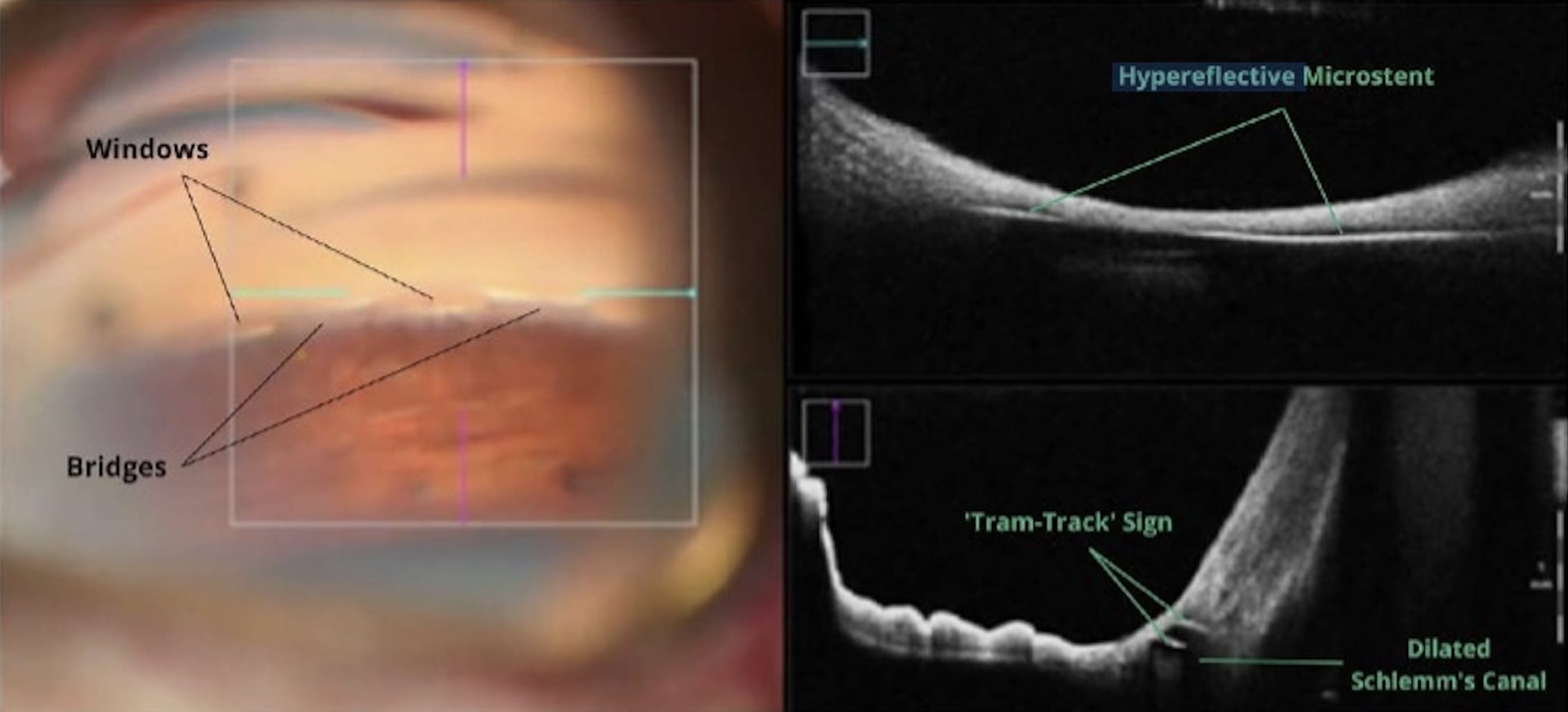 Figure 2. Optimally placed Hydrus microstent (Alcon), visualized on intraoperative optical coherence tomography (iOCT) over a microstent window. On the horizontal axis, the continuous hyperreflective structure lies just below the trabecular meshwork. On the vertical axis, note the “tram-track” sign (characterized by 2 hyperreflective curved lines, with <1 mm distance between them).