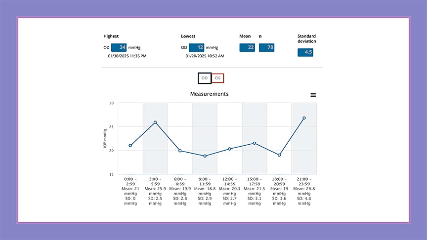 <strong>Figure 1.</strong> Home tonometry results from a patient using the iCare Home2 device over one week revealed IOP fluctuations ranging from 12 to 34 mmHg, with consistent peaks in the mid- to high-20s and low-30s around 4 am and 11 pm—variability that was not evident during routine office visits. Surgical intervention based on these findings resulted in normalization of IOP.</p>