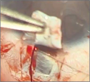 Figure 2. To adequately cannulate Schlemm’s canal, a second flap is create that should be deep enough so the choroidal/ciliary body is visible underneath a few scleral fibers. An illuminated microcatheter (iTrack; Ellex) is introduced into Schlemm’s canal and advanced gently through 360° of the canal.