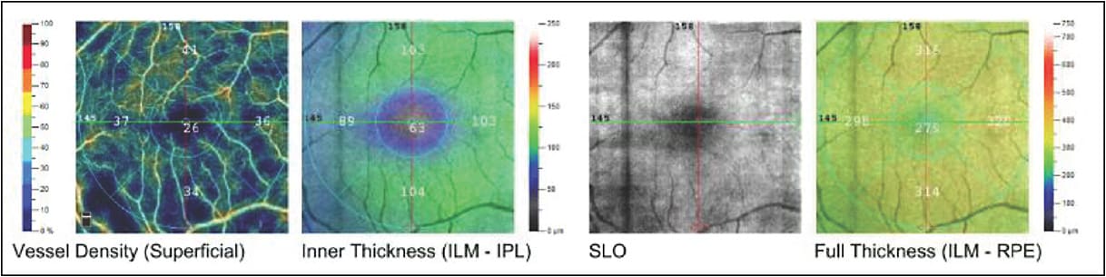 Figure 3. Measurements shown in the AngioAnalytics retina quickVue (Optovue).