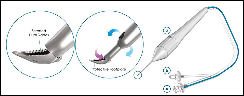 Figure 1. Goniotome has 2 irrigation ports that maintain the chamber (blue arrows). The trabecular meshwork is put under stretch by the ramp of footplate and excised by a left and a right blade. The cut trabecular meshwork strip, blood and debris are aspirated into the tip (purple arrow). Note serrated blades that enhance TM excision. The third image shows the hand piece (A), the aspiration (B), and the Irrigation (C).