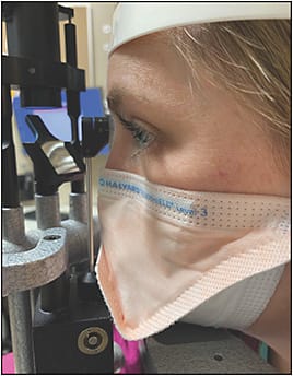 Figure 3. Halyard Fluidshield Surgical N95 Respirator Mask positioned at the slit lamp.