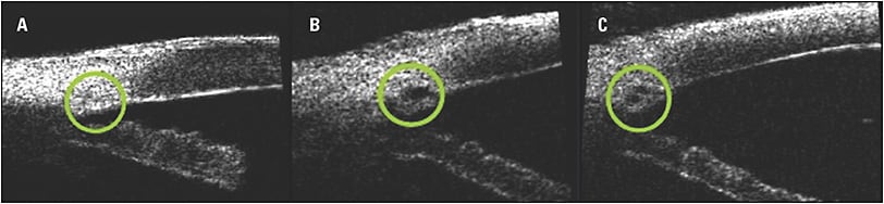 Figure 1. Schlemm’s canal visualized with ultrasound imaging preoperatively (A), after dilation of Schlemm’s canal (B), and after dilation of Schlemm’s canal and collector channels (C).
