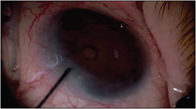 Figure 5. Implantation of iStar MINIject. COURTESY OF STEVEN VOLD, MD, AND ISTAR MEDICAL