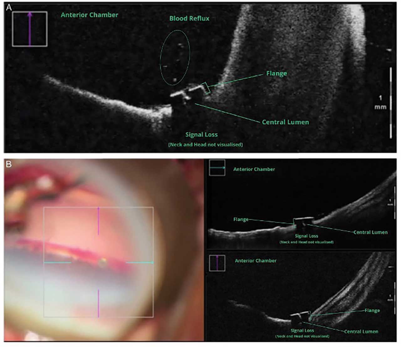 Figure 1. Annotated intraoperative optical coherence tomography (iOCT) image (on the vertical axis) demonstrating features of an optimally placed iStent inject W (Glaukos).