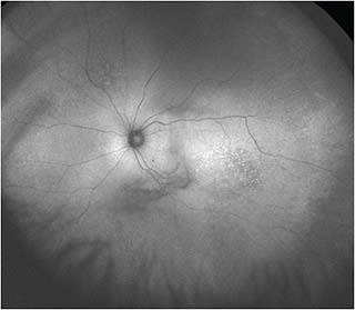 FIGURE 2: This ultrawidefield fundus autofluorescence (FAF) image of the left eye shows hyperautofluorescent spots that correspond to the active white retinal lymphoma lesions in Figure 1. IMAGE COURTESY MUSA ABDELAZIZ, MD