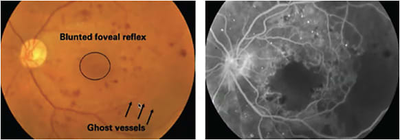 FIGURE 1: Ischemic maculopathy clinical and FFA appearance.