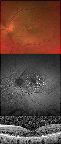 FIGURE 1: In this patient, who has taken pentosan polysulfate sodium for 8 years, pigmentary retinopathy is visible. There is central atrophy that can be seen both in color (by the absence of normal foveal pigmentation) and as a central dark focus on fundus autofluorescence. Optical coherence tomography also demonstrates attenuated subfoveal IS/OS. IMAGE COURTESY ZACK OAKEY, MD