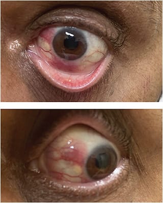 FIGURE 1: External photographs of the left eye of 59-year-old patient show salmon patches and hypopyon. IMAGE COURTESY ALANNA JAMES, MD