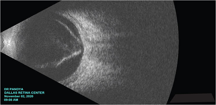 Figure 1: Ultrasound is an important, non-invasive component of the pre-op assessment. In complex funnel retinal detachments, it provides valuable prognostic information.