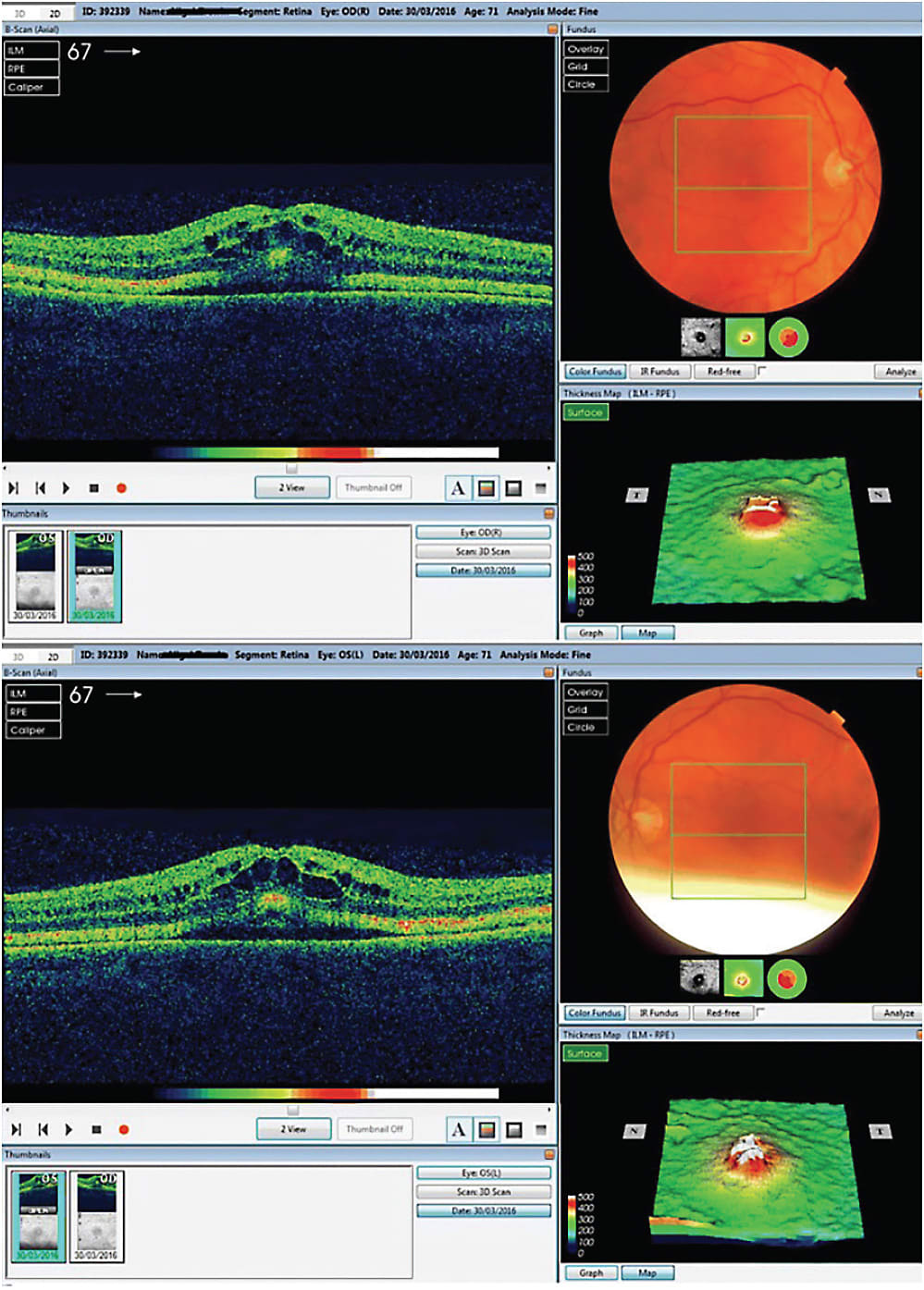 FIGURE 1. Optical coherence tomography (OCT) scan of a 71-year-old patient with melanoma, who had been treated for 4 months with trametinib, a MEK inhibitor. The imaging revealed intraretinal and subretinal fluid on macula with cystoid changes in the perifoveal area in both eyes, with significant thickening of the ellipsoid zone and subretinal granular deposits overlying an apparently intact retinal pigment epithelium (RPE). After cessation of trametinib, the cystoid macular edema resolved over a 6-month period. IMAGE ORIGINALLY PUBLISHED IN: TYAGI P, SANTIAGO C. NEW FEATURES IN MEK RETINOPATHY. BMC OPHTHALMOL. 2018;18(SUPPL 1):221. DOI:10.1186/S12886-018-0861-8. REPRINTED WITH PERMISSION UNDER HTTPS://CREATIVECOMMONS.ORG/LICENSES/BY/4.0/