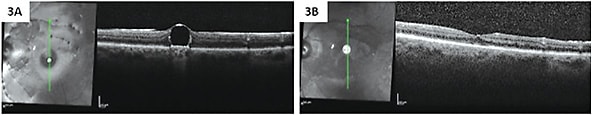 FIGURE 3: The submacular PFO was removed with subretinal BSS injection and PFO removal through induced macular hole. Before surgery (A) vs. postsurgery (B). IMAGE COURTESY OF CARL REGILLO, MD.