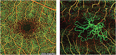 Figure 3. A. Color depth-encoded OCTA of normal retina/choroidal vasculature. B. Choroidal neovascularization on color depth-encoded OCTA.