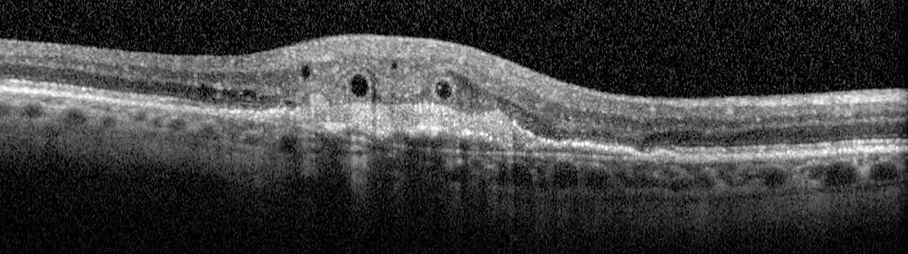 Figure 10. Note the circular pattern of ORT in the outer nuclear layer with hyperreflective band.