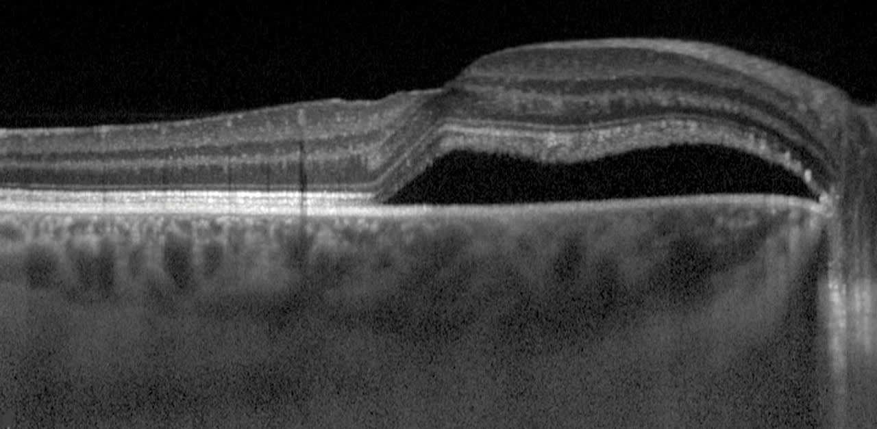 Figure 4 (top) and 5 (bottom). Thickened choroid under the area of subretinal fluid is evident in these EDI OCT scans, confirming the diagnosis of CSCR.