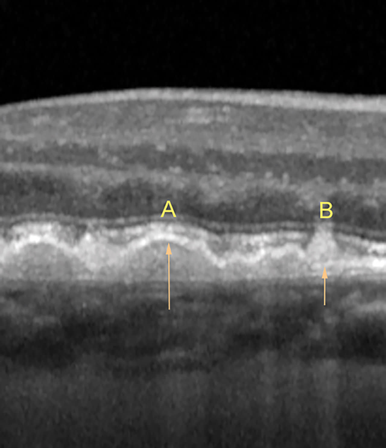 Figure 9. A: Soft drusen. B: Reticular pseudodrusen. Note the RPE (arrows) over the soft drusen and under the pseudodrusen.