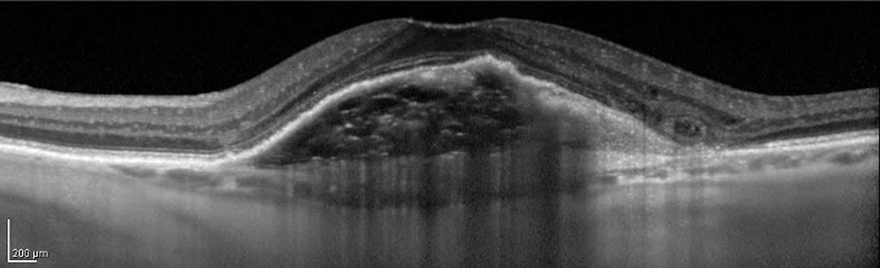 Figure 2. Same pathology imaged with EDI scan (note loss of data resolution at anterior edge of retina)
