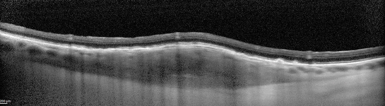 Figure 3. EDI allows for accurate visualization of a mass from anterior to posterior demarcation.