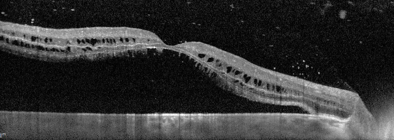 Figure 6. OCT B-scan of a retinal detachment, illustrating separation of all layers of the neuro-sensory retina from the retinal pigment epithelium.