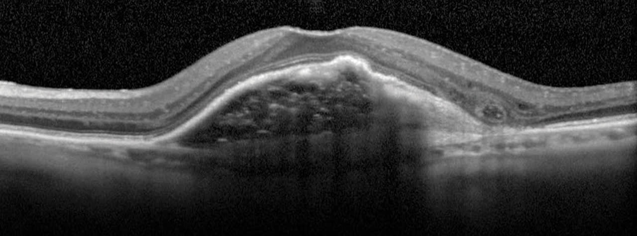 Figure 1. RPE detachment imaged with conventional scan