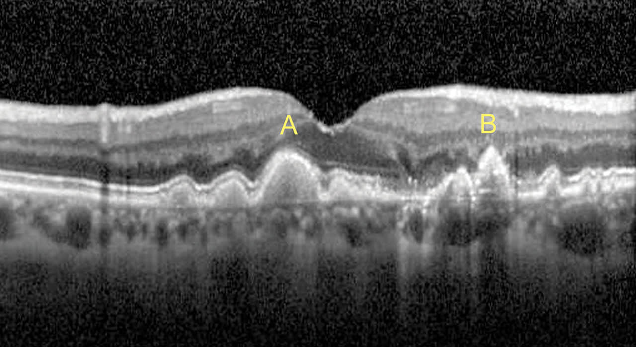 Figure 8. A: Soft drusen. B: Hard drusen