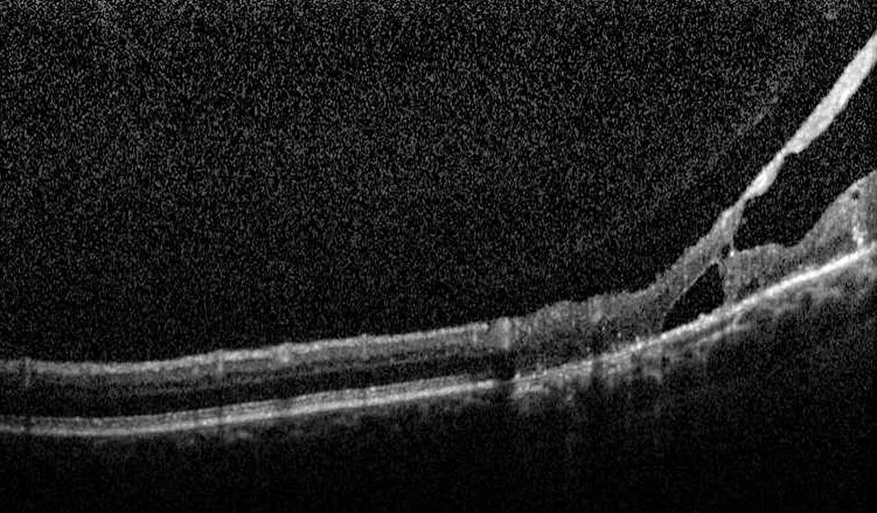 Figure 7. OCT B-scan of retinoschisis, illustrating a splitting of layers within the neuro-sensory retina.