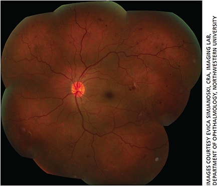 Figure 1. 7-standard field montage fundus photograph demonstrating proliferative diabetic retinopathy.