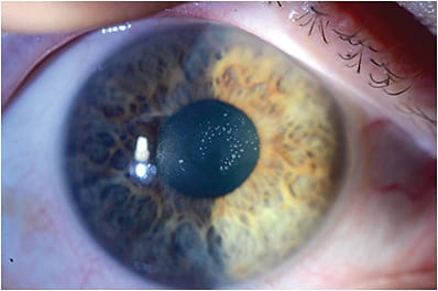 Figure 5. Multiple central microcysts of epithelial basement membrane dystrophy are causing significant visual symptoms in this patient.