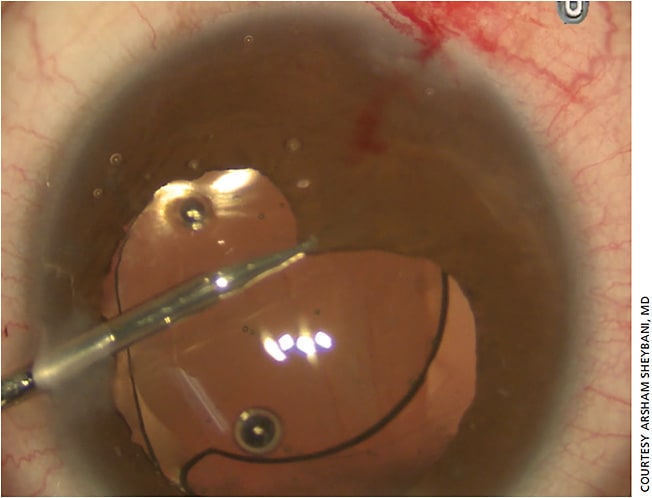Figure 3. Try to bring down iris tissue to determine how much is missing vs. how much is retracted.