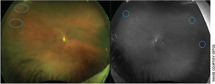 A grade 3, presurgical cataract exam using the Optomap showed early evidence of diabetic retinopathy as numerous dot hemorrhages in both eyes of this patient.